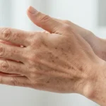 comment enlever les taches brune sur les mains